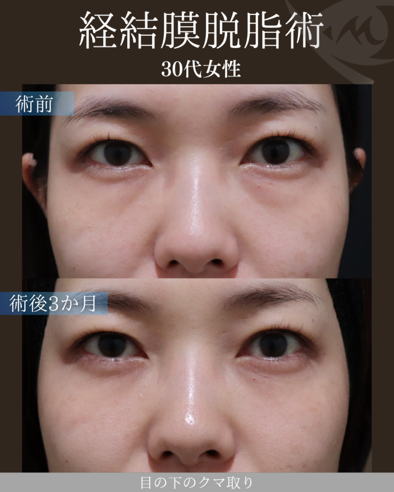 30代女性 経結膜脱脂術 術後3ヶ月